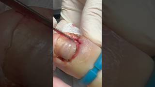 PLUGGED-UP Infected Ingrown Nail Removal #shorts #ingrownnail #satisfying