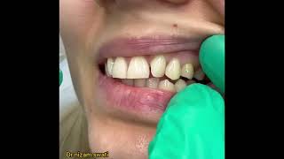 dental dull denture