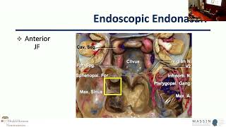 Combined Endoscopic Approaches to Lateral Skull Base | MASSIN Congress Day 3 | Session 9, Talk 6