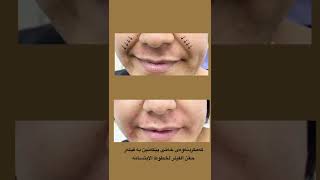 Smile line improvements through the using of dermal