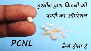 दूरबीन द्वारा किडनी की पथरी का ऑपरेशन | How to Remove Kidney Stone | PCNL Technique for Kidney Stone