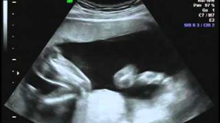 Snyder Ultrasound Pt 2