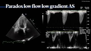 〖Echocardiography〗 Low-flow-low-gradient AS & paradox low-flow-low gradient, true & pseudosevere AS