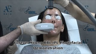 Forever Young BBL IPL Photofacial Demonstration 38 - A E Skin - Encino, CA - 818-835-1833