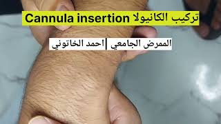 تركيب كانيولا Cannula insertion