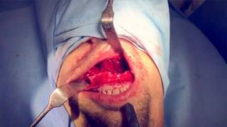 BiMax Surgery using SynpliciTi  (Created with @Magisto)