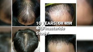 Finasteride||10 year finasteride results| FINASTERIDE SIDE EFFECTS|RECEDING HAIRLINE| Hindi