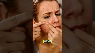 What Dermatologist Don't Want You To Know #acne #skincare #health