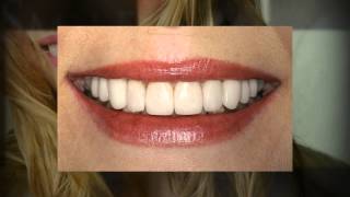 Dental Implants Hertfordshire - Perfect Smile Studios