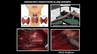 ENDOSCOPIC PARATHYROID GLAND SURGERY - Dr Atul Mishra