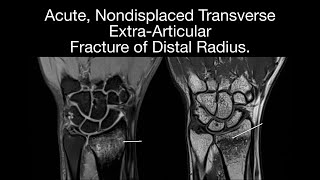 Acute, Nondisplaced Transverse Extra-Articular Fracture of Distal Radius.