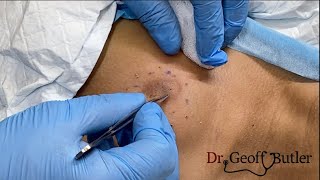 Removal of an epidermal cyst on the upper chest