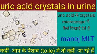 uric acid crystals in urine / crystals in urine / identify uric acid crystals in urine