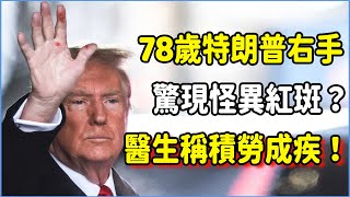 特朗普右手驚現怪異紅色斑點？美國大選結束後78歲高齡特朗普還能堅持多久，私人醫生曝其已積勞成疾？ #talkshow #圆桌派 #窦文涛 #脱口秀 #真人秀 #圆桌派第七季 #马未都