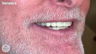 Veneers