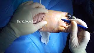 Transmetatarsal Foot Amputation Surgery Technique guide by Dr. Kolodenker Diabetic Foot