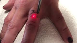 Wedding band tattoo removal, ring finger laser tattoo removal