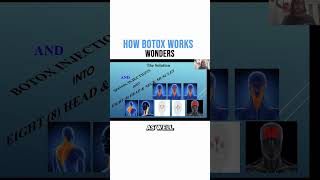 How Botox Works Wonders!