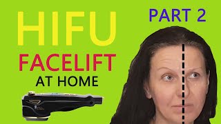 HIFU Face Lift at Home - PART 2 demonstration and review