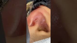 Blackheads In Ear