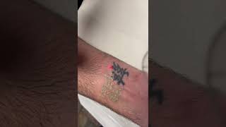 Laser tattoo removal wriat tattoo at Excellase Raleigh