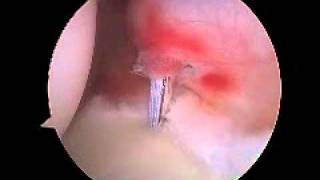 Arthroscopic percutaenous posterior labrum repair