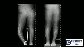 Knee Deformities: acute Vs gradual correction - O Lahoti