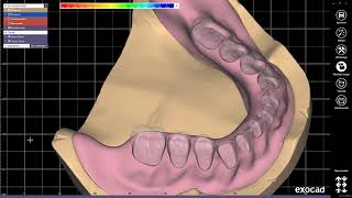 full denture