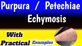 petechiae vs ecchymosis vs purpura