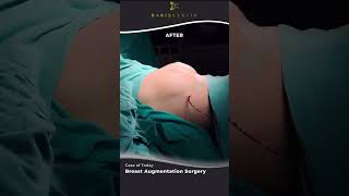 Breast Augmentation Surgery Before&After  #breastaugmentationsurgeon  #güzellik