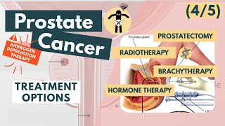 Treatment of prostate cancer | Overview for Med Students | Urology