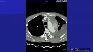 CASE LÂM SÀNG: VỠ PHÌNH ĐỘNG MẠCH CHỦ NGỰC ĐÃ CAN THIỆP STENT GRAFT