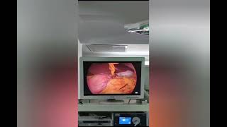 "Situs inversus totalis" orqanların total əks yerləşimi+mədəkiçiltmə əməliyyatı(Sleeve gastrectomy)