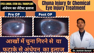 New Eye treatment for BLINDNESS from Chuna (Chemical ( eye )injury |imbal stem cell transplant.