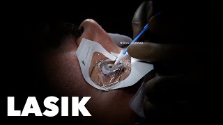 LASIK | Surgery Video in 3rd Person POV