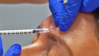 Botox Procedure At A local Med Spa In San Antonio, Texas!