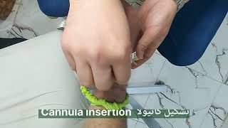 تشكيل كانيولا Cannula insertion