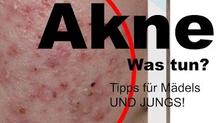 Akne - Was tun? Tipps für Mädels UND JUNGS!