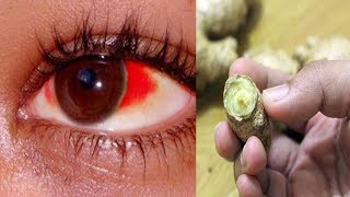 3 Ingredients That Cure Clogged Arteries,Fat In The Blood And Infections | very effectively