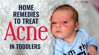 Home Remedies To Treat Acne In Toddlers