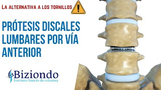 ▷▷Cirugía de columna lumbar sin tornillos: Prótesis discales lumbares por vía abdominal | Biziondo