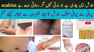 kharish khatam karne ka tarika | how to get rid of scabies Dr Mushtaq Ahmad