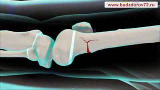 Medical Animation. Broken leg in children