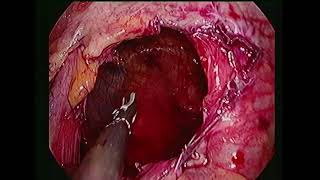 laparoscopic surgery for gastric volvulus