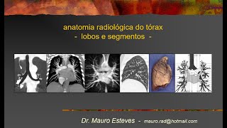 Anatomia - Lobos e segmentos pulmonares