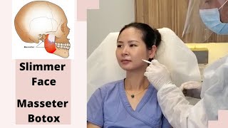 Botox Injections to Masseter Muscles (How to get slimmer face?)