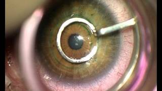 Implantation of Intrastromal Corneal Ring Segments