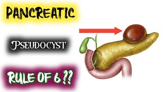 rule of six in pancreatic pseudocyst | rule of 6