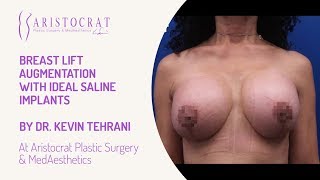 Breast Lift Augmentation IDEAL Saline Implants Long Island, New York by Dr. Kevin Tehrani