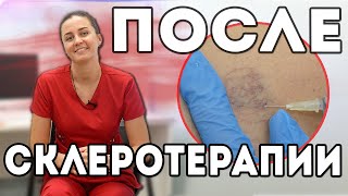 Период восстановления после склеротерапии